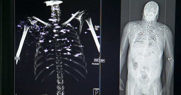 Radiographie d'un corps criblé de balles