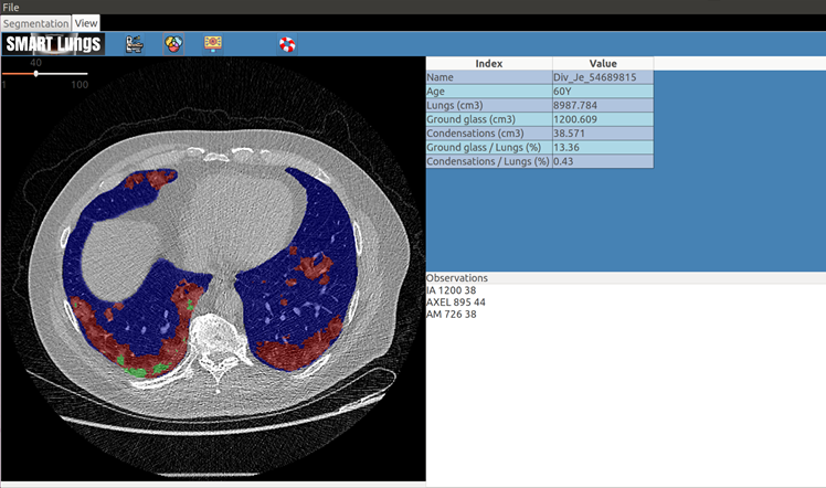 Interface Smartlungs