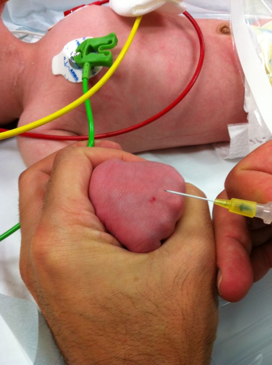 Prise de sang bébé