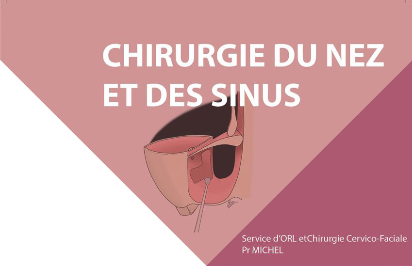 fiche pathologie du service ORL et chirurgie cervico-faciale de l'Hôpital de la Conception de Marseille